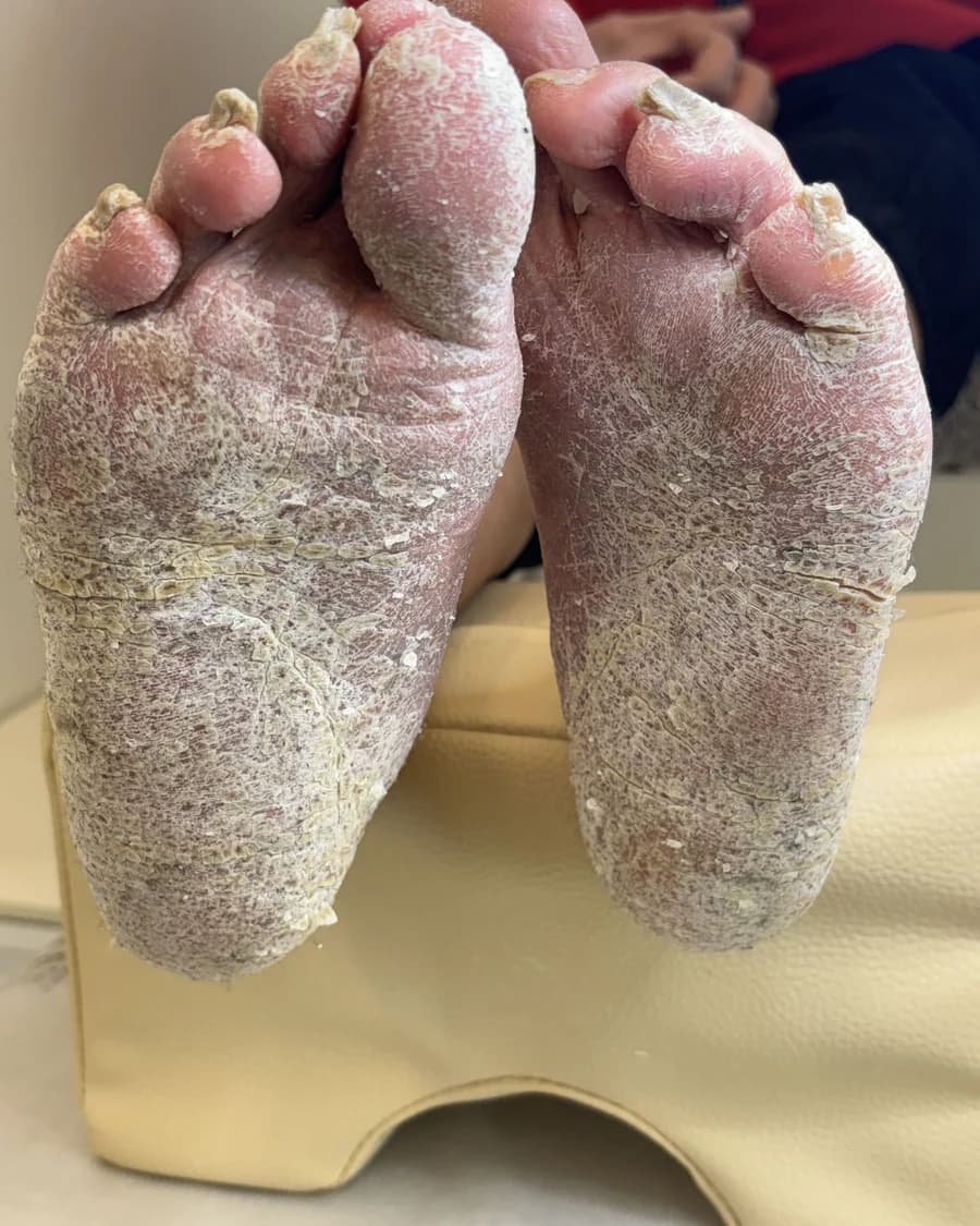 관리가 필요한 상태 — 발각질 · 굳은살 스케일링