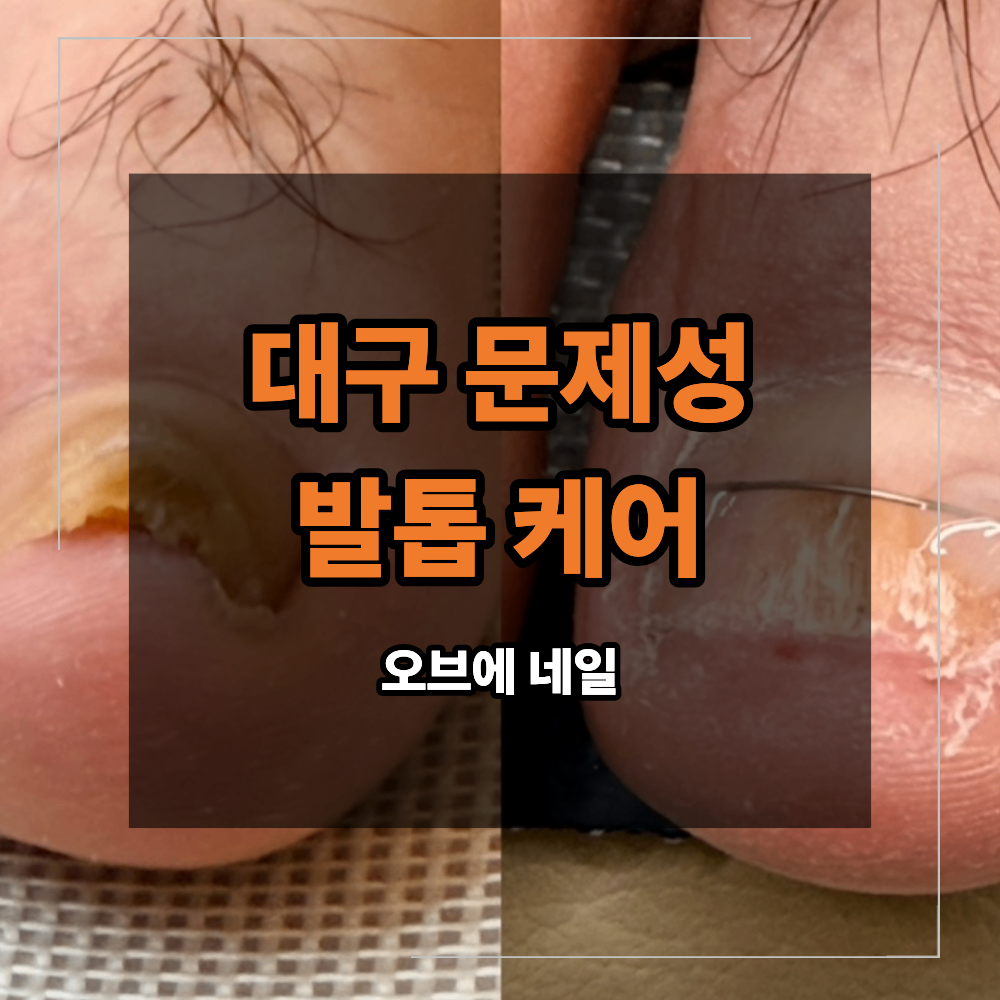 대구 문제성 두꺼운 발톱 케어 두껍고 말린 발톱은 어떻게 관리 할까?