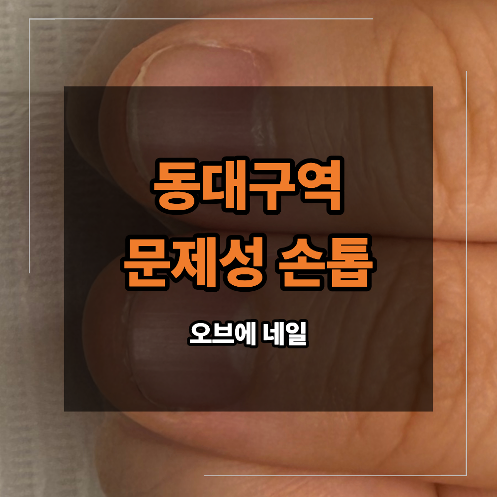 동대구역 문제성 손톱 관리 짧고 뭉툭한 손톱은 교정 필요한 이유