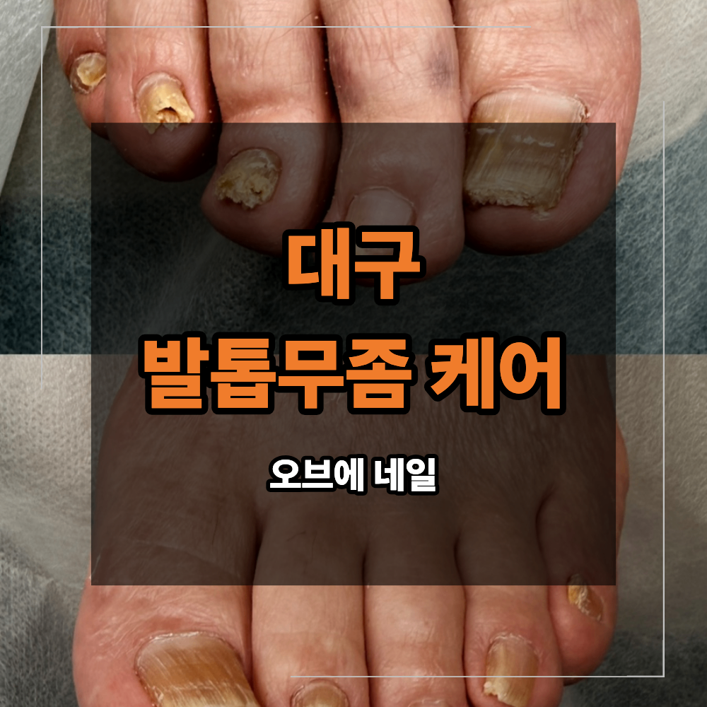 대구 신천동 무좀 발톱 케어 반복되는 재발 두꺼워짐 원인