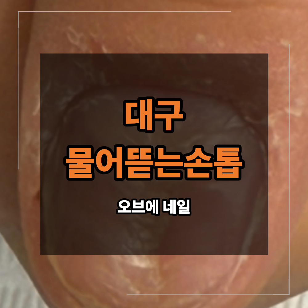 대구 물어 뜯는 손톱 교정 반복되는 이유
