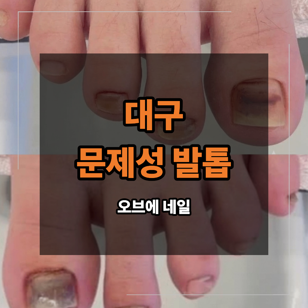 대구 문제성 발톱 케어 찧었을 때 피멍 복원