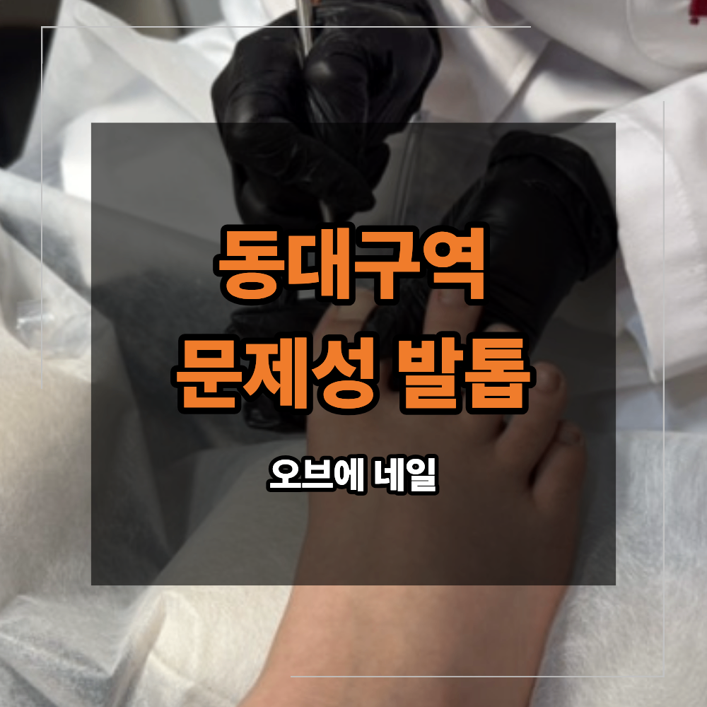 동대구역 문제성 발톱 두꺼워지고 변색 되면 확인 할 부분