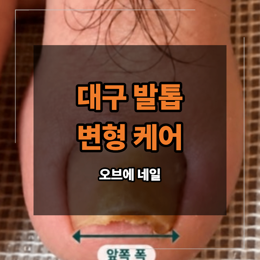 대구 발톱 변형 케어 반복되는 두꺼움 색 변화 관리