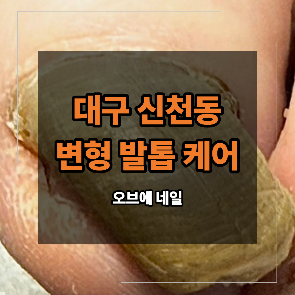 대구 신천동 발톱 케어 두껍게 변형 되는 이유